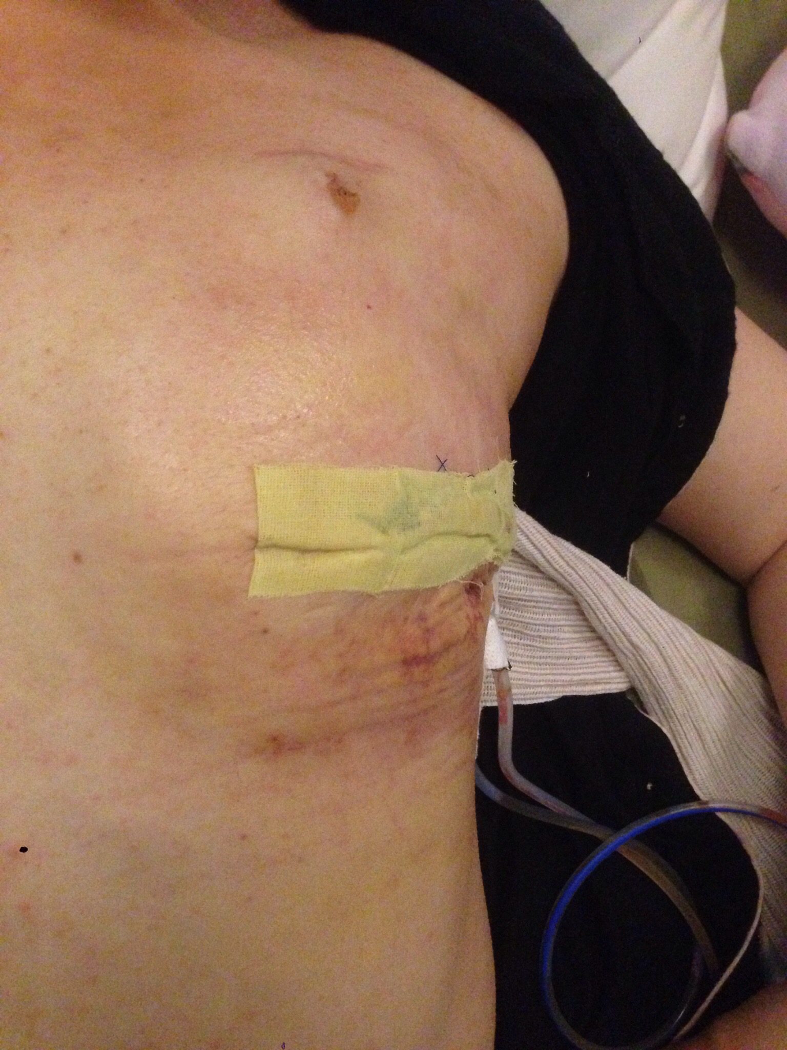 Surgery 2- healing chest