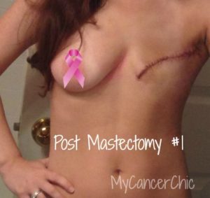 Post Mastectomy #1