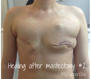 mastectomy 2 healing