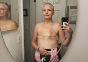 post chemo and mastectomy